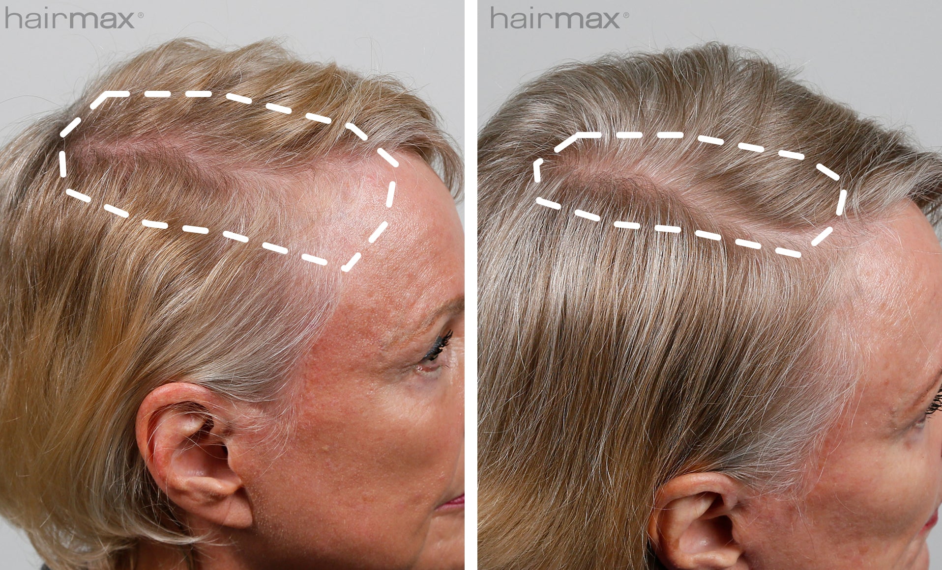 Carol Before & After